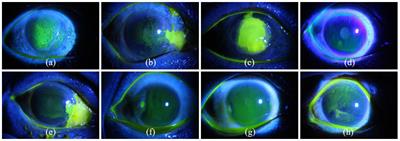 Multi-scale information fusion network with label smoothing strategy for corneal ulcer classification in slit lamp images